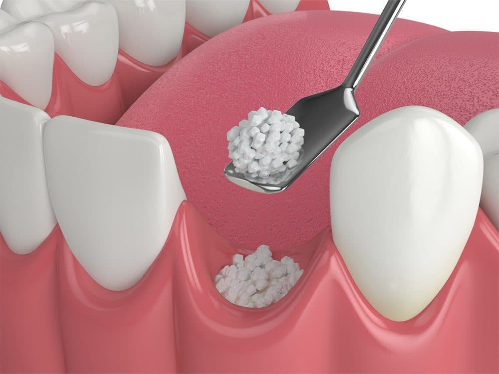Regenerative Bone Surgery