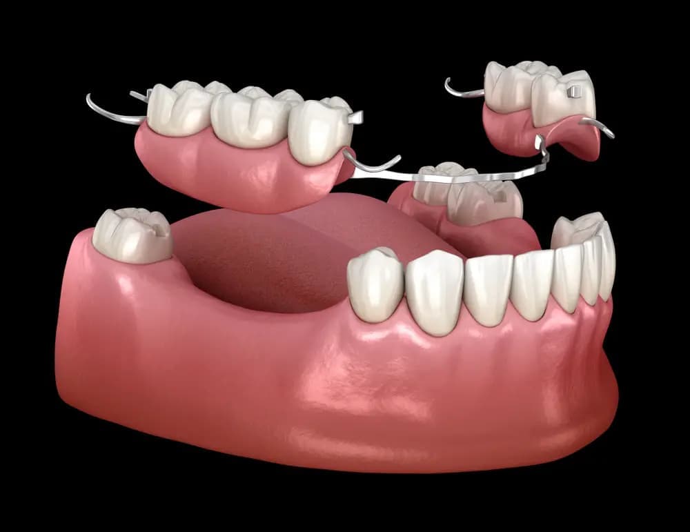 Dental Flippers