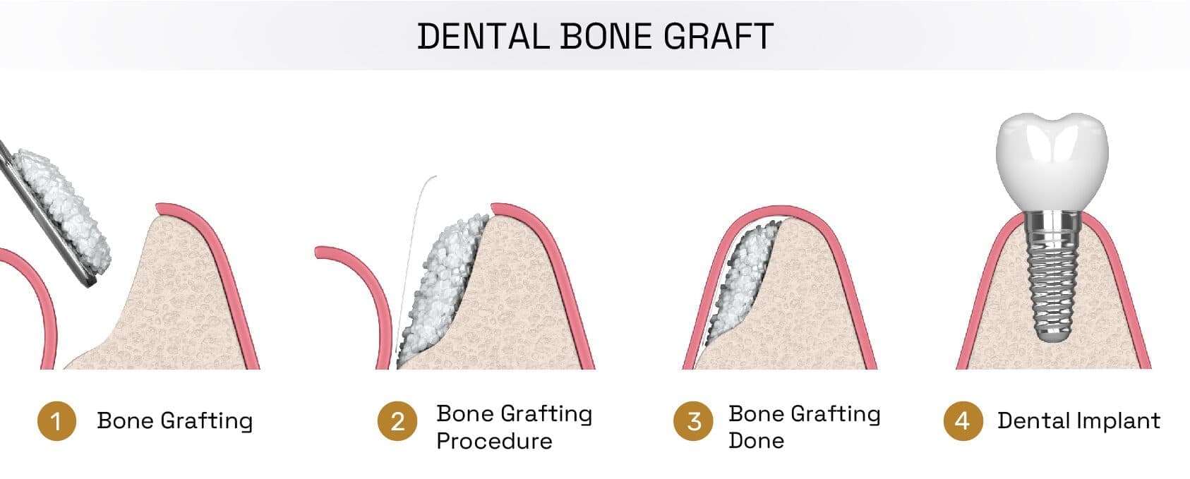 Extraction & Bone Graft