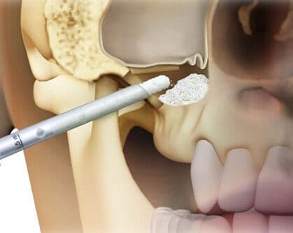 Sinus Lift Surgery