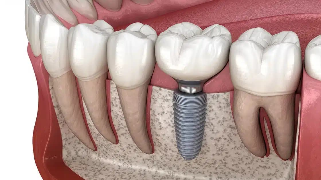 Zygomatic Implants