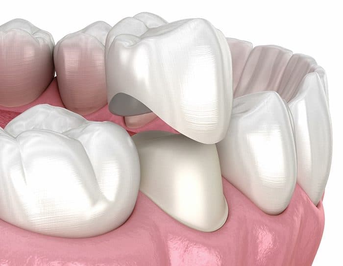 Zirconia Crown