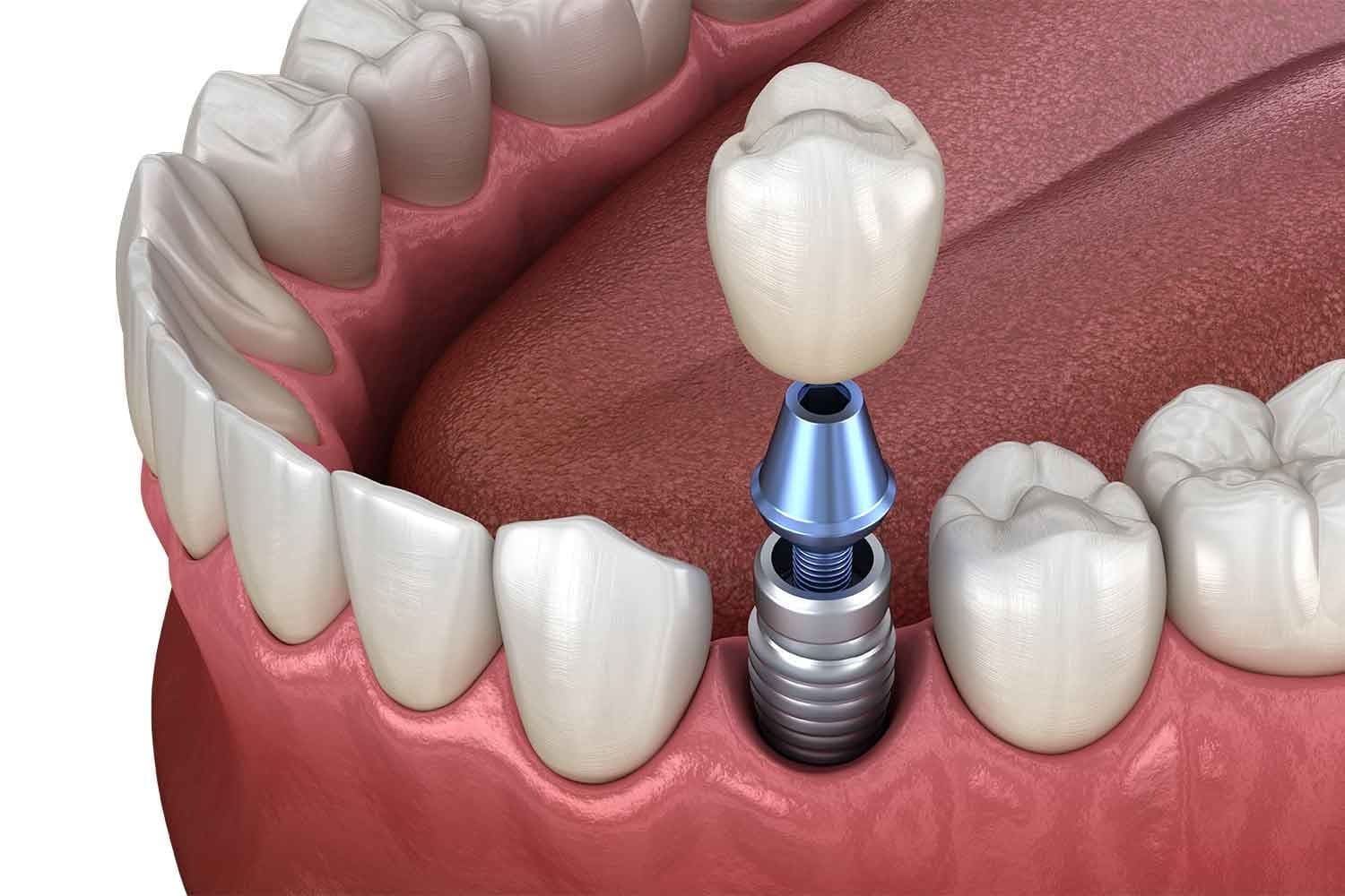 The crown, abutment, and titanium implant our in-house lab designs and finishes for each case