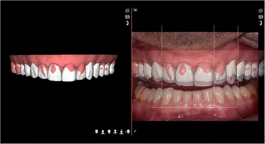 Teeth Whitening
