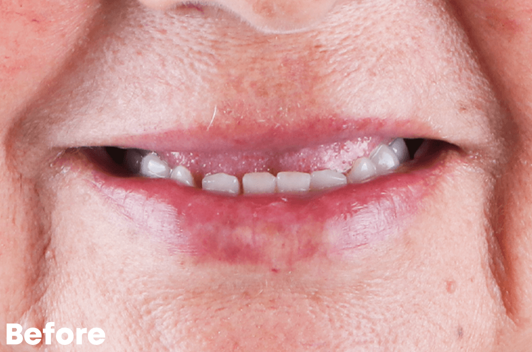 Before — All-on-4 Upper Arch