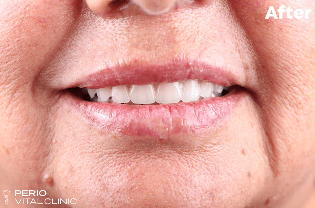 After — All-on-4 Upper Arch