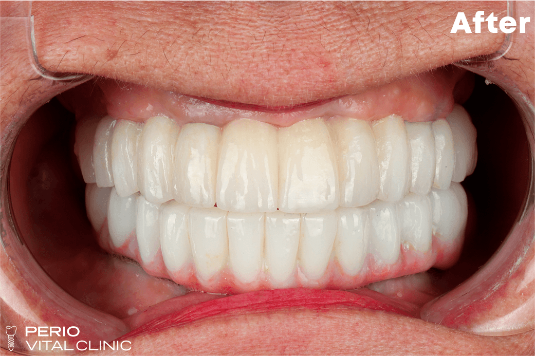 After — All-on-4 Full Arch