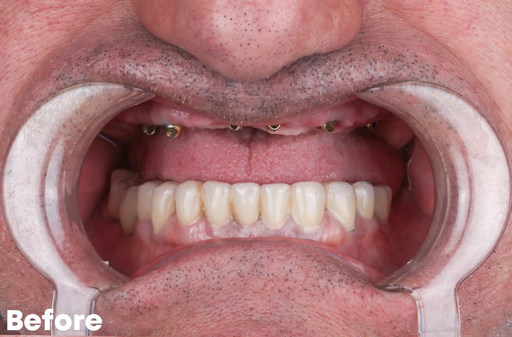 Before — implant case