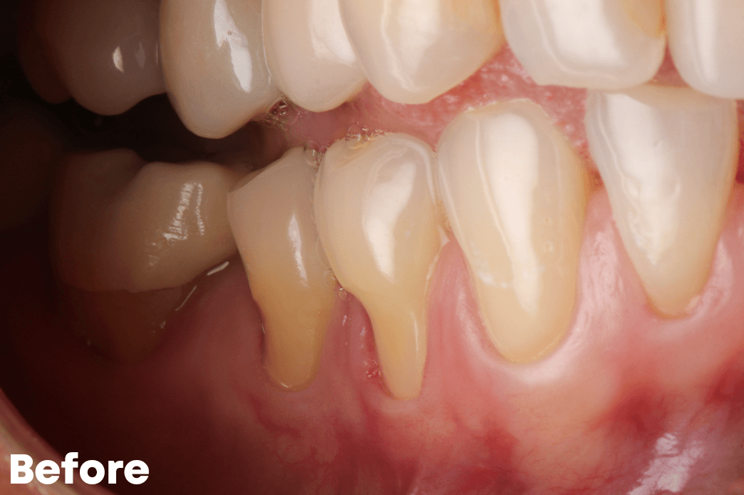 Before — Gum Grafting