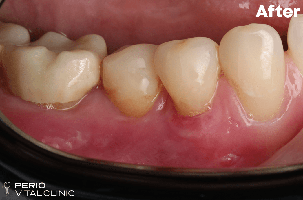 After — Gum Grafting