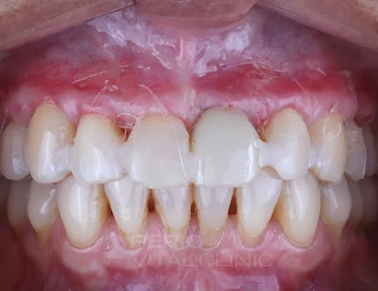 Receding gums & sensitivity