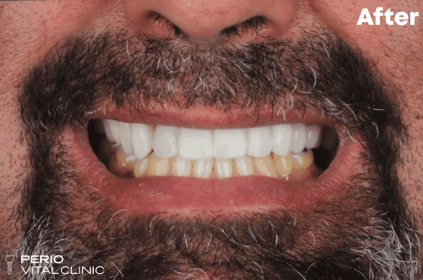 After — implant case