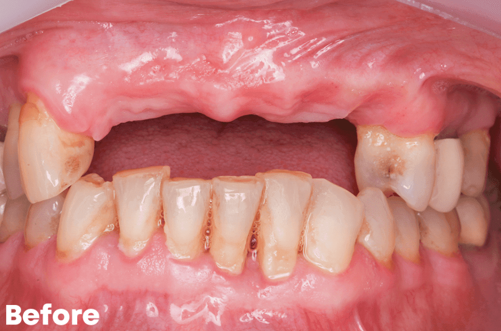 Before — implant case