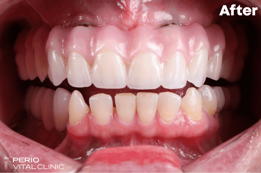 After — implant case