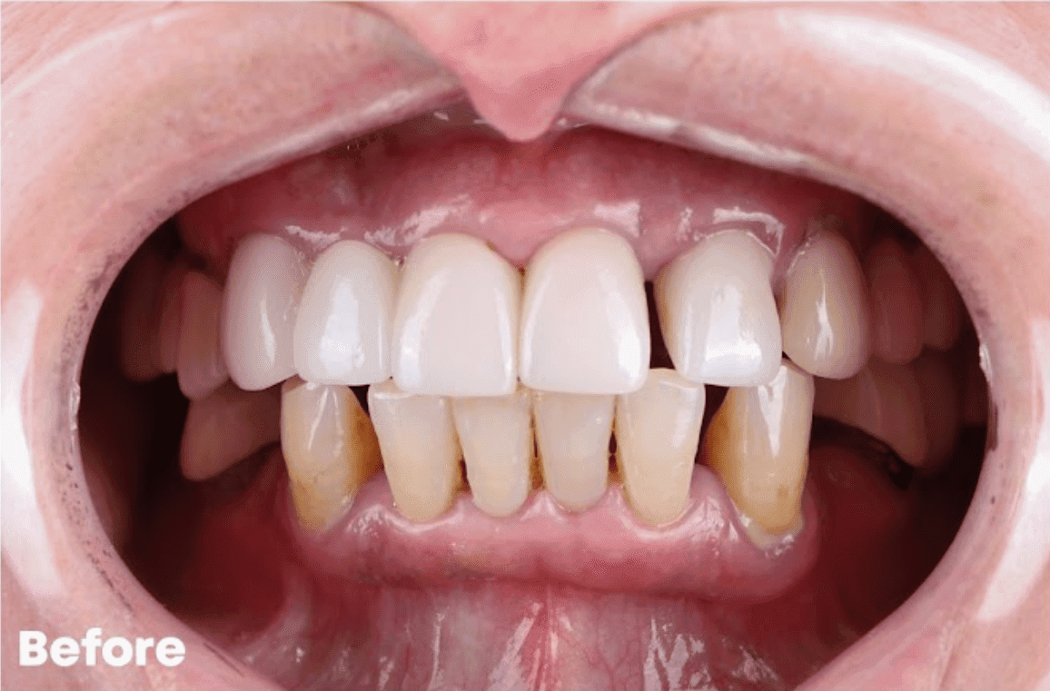 Before — implant case