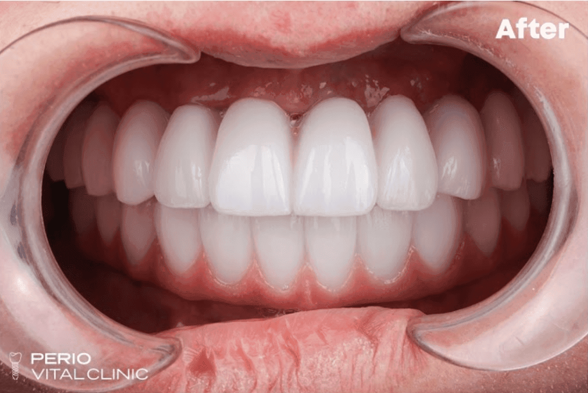 After — implant case
